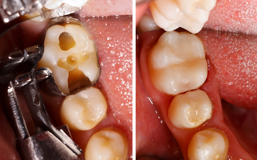 Fuellungen München, Stachus Innenstadt Zahnarzt im Mund