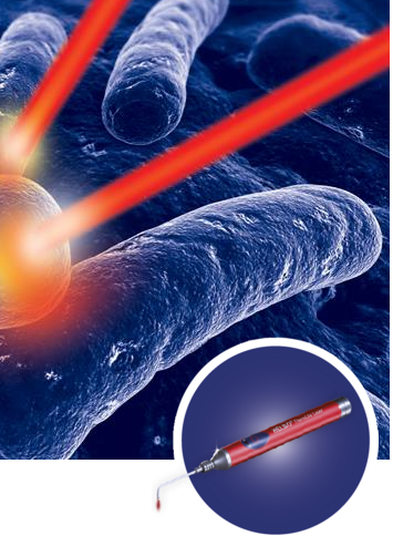 Lasertherapie bei oralen Infektionen München, Stachus Innenstadt Zahnarzt Helbo